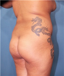 Buttock Lift with Augmentation Before Photo by Marvin Shienbaum, MD; Brandon, FL - Case 37262