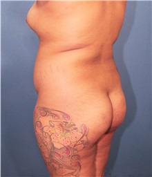 Buttock Lift with Augmentation Before Photo by Marvin Shienbaum, MD; Brandon, FL - Case 37262