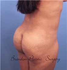 Buttock Lift with Augmentation After Photo by Marvin Shienbaum, MD; Brandon, FL - Case 37263