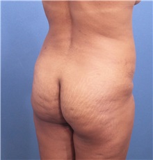 Buttock Lift with Augmentation Before Photo by Marvin Shienbaum, MD; Brandon, FL - Case 37263