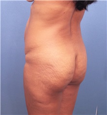 Buttock Lift with Augmentation Before Photo by Marvin Shienbaum, MD; Brandon, FL - Case 37263