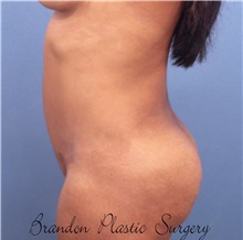 Buttock Lift with Augmentation After Photo by Marvin Shienbaum, MD; Brandon, FL - Case 37263