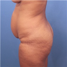 Buttock Lift with Augmentation Before Photo by Marvin Shienbaum, MD; Brandon, FL - Case 37263