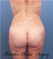 Buttock Lift with Augmentation After Photo by Marvin Shienbaum, MD; Brandon, FL - Case 37264