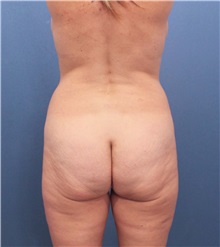 Buttock Lift with Augmentation Before Photo by Marvin Shienbaum, MD; Brandon, FL - Case 37264