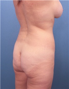 Buttock Lift with Augmentation Before Photo by Marvin Shienbaum, MD; Brandon, FL - Case 37264