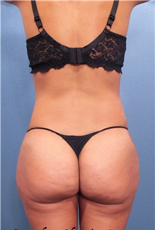 Buttock Lift with Augmentation After Photo by Marvin Shienbaum, MD; Brandon, FL - Case 37265