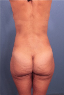 Buttock Lift with Augmentation Before Photo by Marvin Shienbaum, MD; Brandon, FL - Case 37265