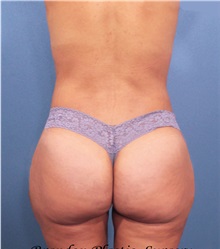 Buttock Lift with Augmentation After Photo by Marvin Shienbaum, MD; Brandon, FL - Case 37266