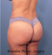 Buttock Lift with Augmentation After Photo by Marvin Shienbaum, MD; Brandon, FL - Case 37266