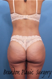 Buttock Lift with Augmentation After Photo by Marvin Shienbaum, MD; Brandon, FL - Case 37267