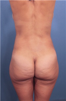 Buttock Lift with Augmentation Before Photo by Marvin Shienbaum, MD; Brandon, FL - Case 37267