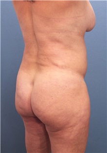 Buttock Lift with Augmentation Before Photo by Marvin Shienbaum, MD; Brandon, FL - Case 37270