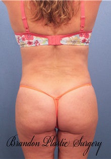 Buttock Lift with Augmentation After Photo by Marvin Shienbaum, MD; Brandon, FL - Case 37270