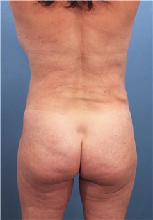 Buttock Lift with Augmentation Before Photo by Marvin Shienbaum, MD; Brandon, FL - Case 37270