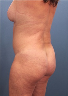 Buttock Lift with Augmentation Before Photo by Marvin Shienbaum, MD; Brandon, FL - Case 37270