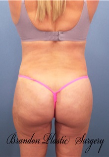 Buttock Lift with Augmentation After Photo by Marvin Shienbaum, MD; Brandon, FL - Case 37271