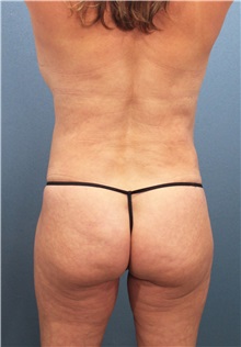 Buttock Lift with Augmentation Before Photo by Marvin Shienbaum, MD; Brandon, FL - Case 37271