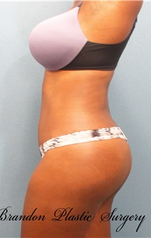 Buttock Lift with Augmentation After Photo by Marvin Shienbaum, MD; Brandon, FL - Case 37272