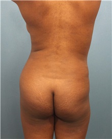 Buttock Lift with Augmentation Before Photo by Marvin Shienbaum, MD; Brandon, FL - Case 37272