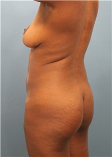 Buttock Lift with Augmentation Before Photo by Marvin Shienbaum, MD; Brandon, FL - Case 37272