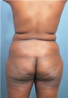 Buttock Lift with Augmentation Before Photo by Marvin Shienbaum, MD; Brandon, FL - Case 37273