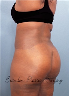 Buttock Lift with Augmentation After Photo by Marvin Shienbaum, MD; Brandon, FL - Case 37273