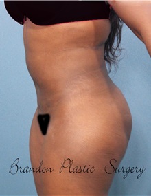 Buttock Lift with Augmentation After Photo by Marvin Shienbaum, MD; Brandon, FL - Case 37273