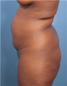 Buttock Lift with Augmentation Before Photo by Marvin Shienbaum, MD; Brandon, FL - Case 37273