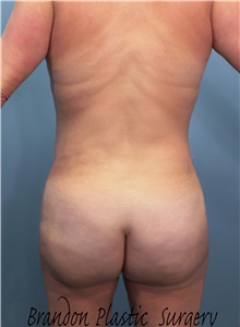 Buttock Lift with Augmentation After Photo by Marvin Shienbaum, MD; Brandon, FL - Case 37274