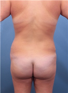 Buttock Lift with Augmentation Before Photo by Marvin Shienbaum, MD; Brandon, FL - Case 37274