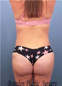 Buttock Lift with Augmentation After Photo by Marvin Shienbaum, MD; Brandon, FL - Case 37276