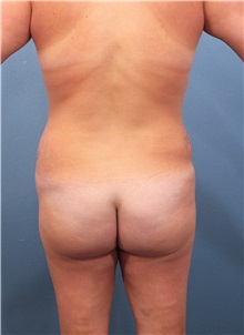 Buttock Lift with Augmentation Before Photo by Marvin Shienbaum, MD; Brandon, FL - Case 37276