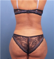 Buttock Lift with Augmentation After Photo by Marvin Shienbaum, MD; Brandon, FL - Case 37279