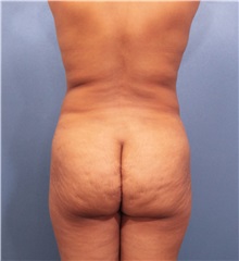 Buttock Lift with Augmentation Before Photo by Marvin Shienbaum, MD; Brandon, FL - Case 37279