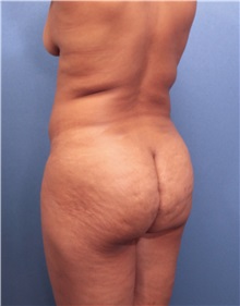 Buttock Lift with Augmentation Before Photo by Marvin Shienbaum, MD; Brandon, FL - Case 37279