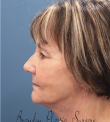 Facelift After Photo by Marvin Shienbaum, MD; Brandon, FL - Case 37318