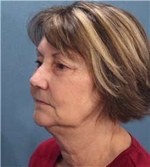 Facelift Before Photo by Marvin Shienbaum, MD; Brandon, FL - Case 37318