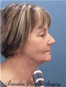 Facelift After Photo by Marvin Shienbaum, MD; Brandon, FL - Case 37318