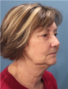 Facelift Before Photo by Marvin Shienbaum, MD; Brandon, FL - Case 37318