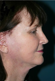 Facelift After Photo by Marvin Shienbaum, MD; Brandon, FL - Case 37319