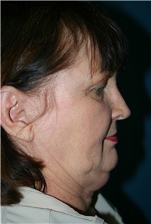 Facelift Before Photo by Marvin Shienbaum, MD; Brandon, FL - Case 37319
