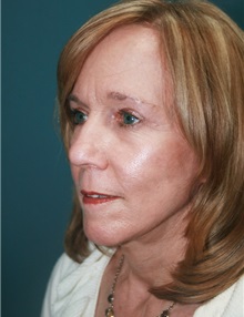 Facelift After Photo by Marvin Shienbaum, MD; Brandon, FL - Case 37320