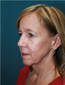 Facelift Before Photo by Marvin Shienbaum, MD; Brandon, FL - Case 37320