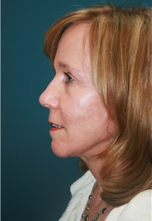 Facelift After Photo by Marvin Shienbaum, MD; Brandon, FL - Case 37320