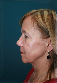 Facelift Before Photo by Marvin Shienbaum, MD; Brandon, FL - Case 37320