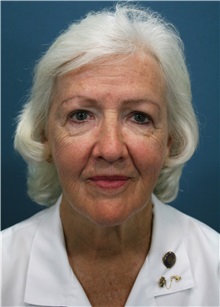 Facelift Before Photo by Marvin Shienbaum, MD; Brandon, FL - Case 37321