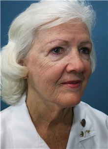 Facelift Before Photo by Marvin Shienbaum, MD; Brandon, FL - Case 37321