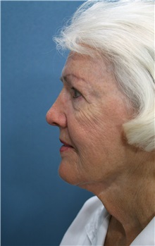 Facelift Before Photo by Marvin Shienbaum, MD; Brandon, FL - Case 37321