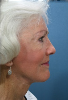 Facelift After Photo by Marvin Shienbaum, MD; Brandon, FL - Case 37321